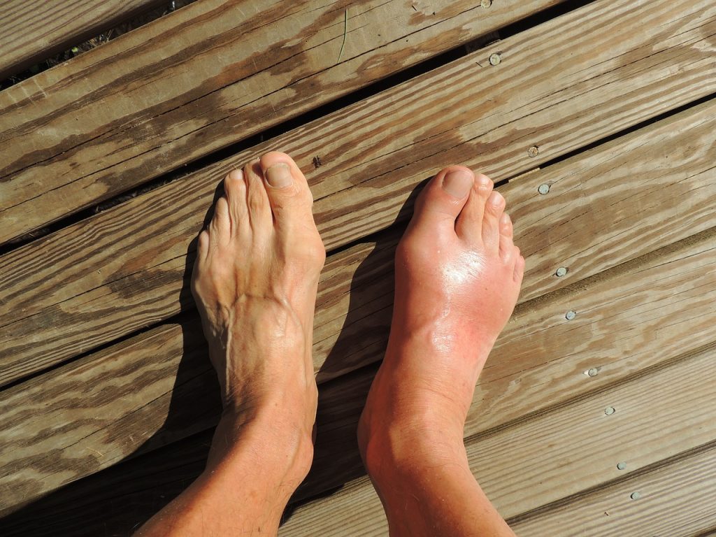 Swollen-Foot